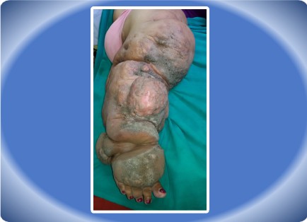 LYMPHOEDEMA LOWER LIMB